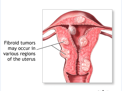 Discover Relief with Our Fibroid Natural Eradication Therapy Pack